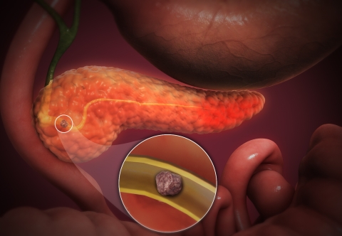 Những yếu tố nào làm tăng nguy cơ mắc viêm phúc mạc?